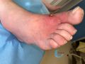 Pied infecté23.jpg