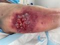Pyoderma gangrenosum67.jpg