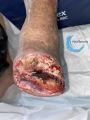 Amputation65.jpg