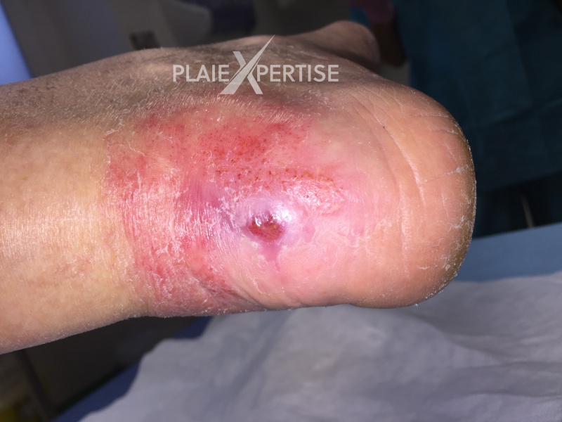 Fichier:Dermite d'irritation1.jpg