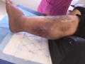 Grosses jambes suintantes26.png