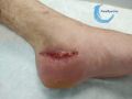 Epidermisation11.jpg