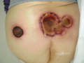 Lymphome cutané ulcéré5.png