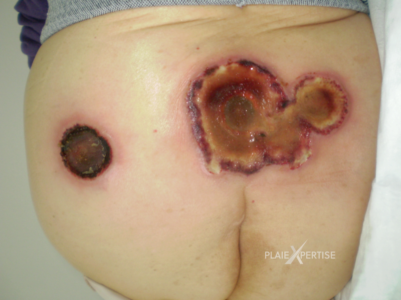 Fichier:Lymphome cutané ulcéré5.png