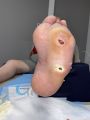 Pied de Charcot43.jpg