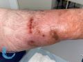 Pustules22.jpg