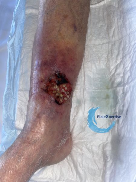 Fichier:Angiodermite typique76.jpg