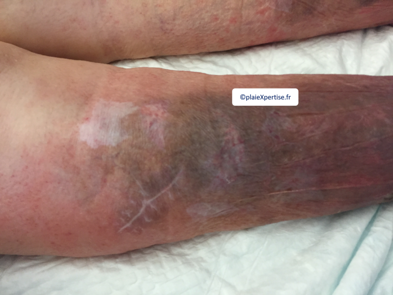 Fichier:Dermatoporose18.png