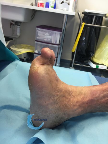 Fichier:Pied déformé10.jpg