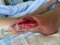 Tendon-Reliquat19.jpg