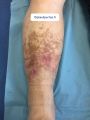 Dermiteocre9.png