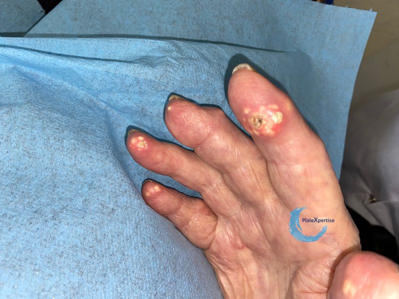 Fichier:Goutte et tophus44.jpg