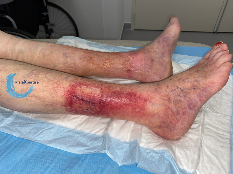 Fichier:Dermatoporose29.png