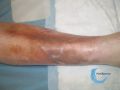 Dermatoporose38.jpg