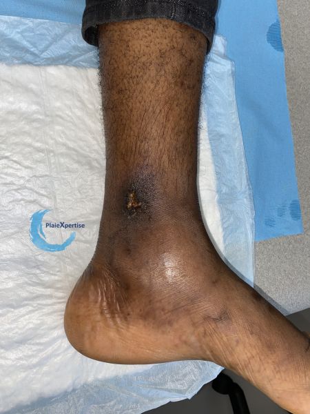 Fichier:Drépanocytose20.jpg