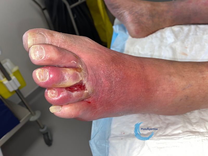 Fichier:Pied infecté1.jpg
