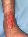 Tendon-Reliquat13.png