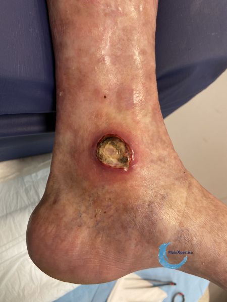Fichier:Angiodermite typique134.jpg
