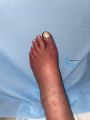 Erythrocyanose30.jpg