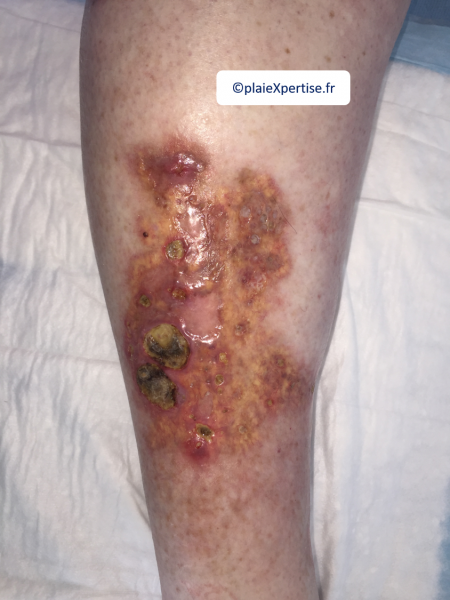 Fichier:Nécrobiose lipoïdique2.png
