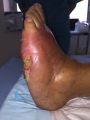 Pied de Charcot51.jpg