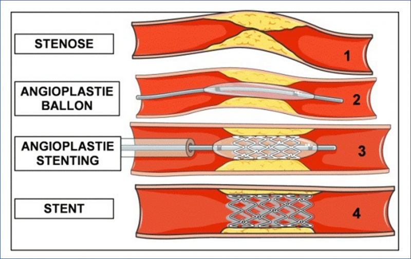 Fichier:Stenting.png