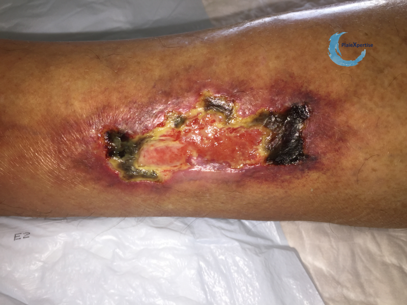 Fichier:Angiodermite typique59.png