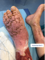 Lymphoedème pied6.png