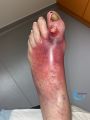 Pied infecté16.jpg