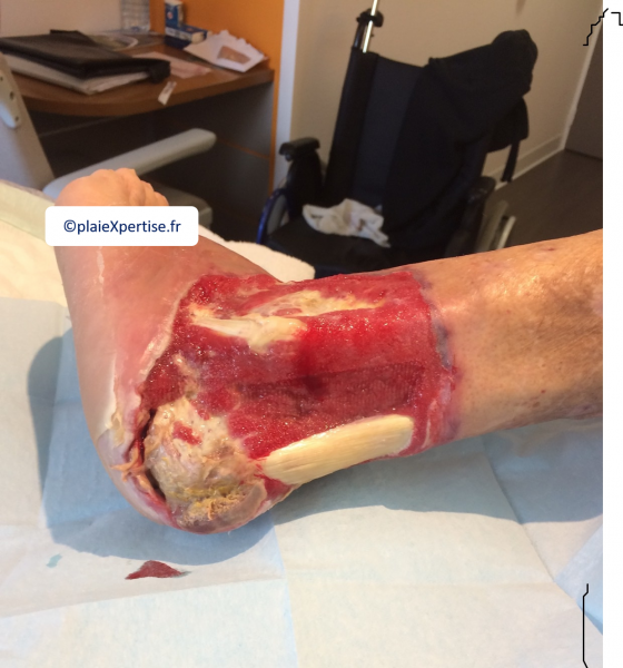 Fichier:Tendon normal17.png
