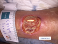 Tendon normal3.png