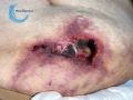 Calciphylaxie9.jpg