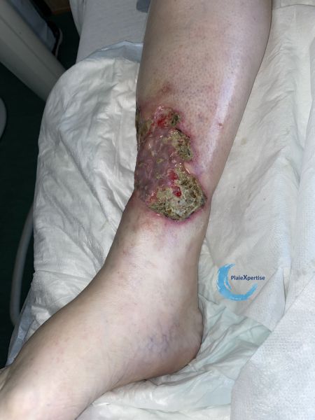 Fichier:Nécrose humide129.jpg