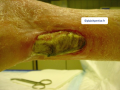 Tendon nécrotique humide5.png
