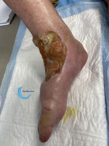Fichier:Cou de pied84.jpg