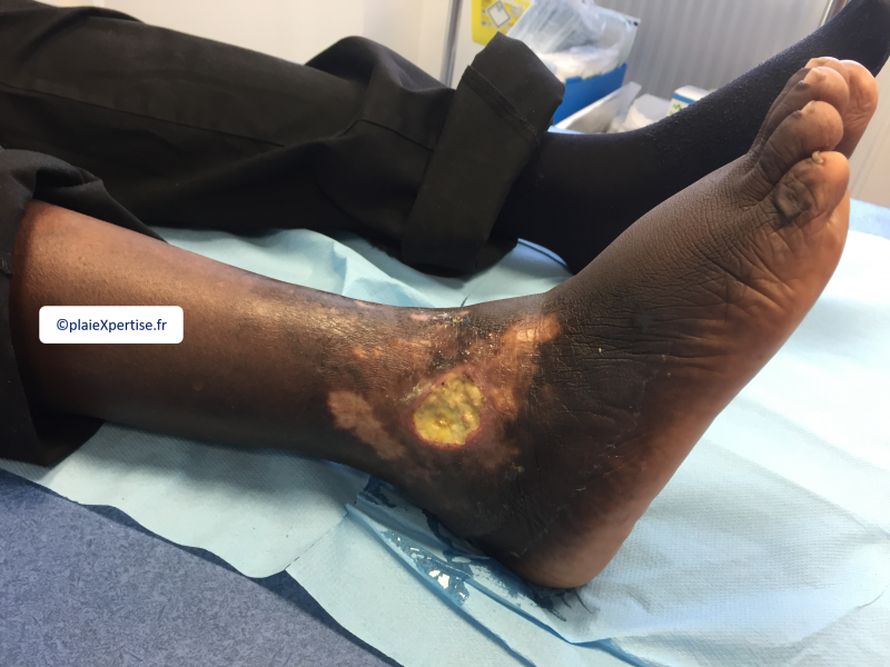 Fichier:Drépanocytose3.png