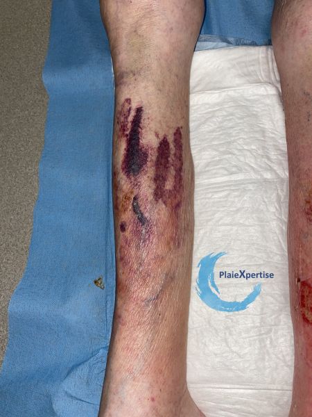 Fichier:Dermatoporose40.jpg