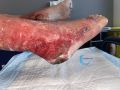 Dermite d'irritation145.jpg