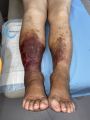 Dermiteocre87.jpg