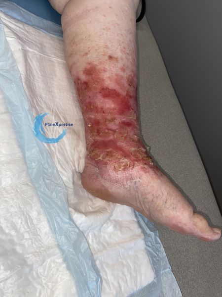 Fichier:Eczéma126.jpg