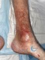 Dermite d'irritation140.jpg