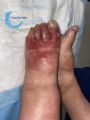 Eczéma103.jpg