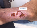 Tissu de granulation inflammatoire15.png