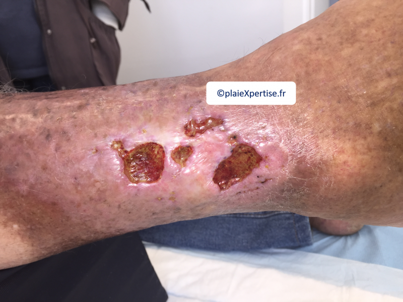 Fichier:Tissu de granulation inflammatoire15.png