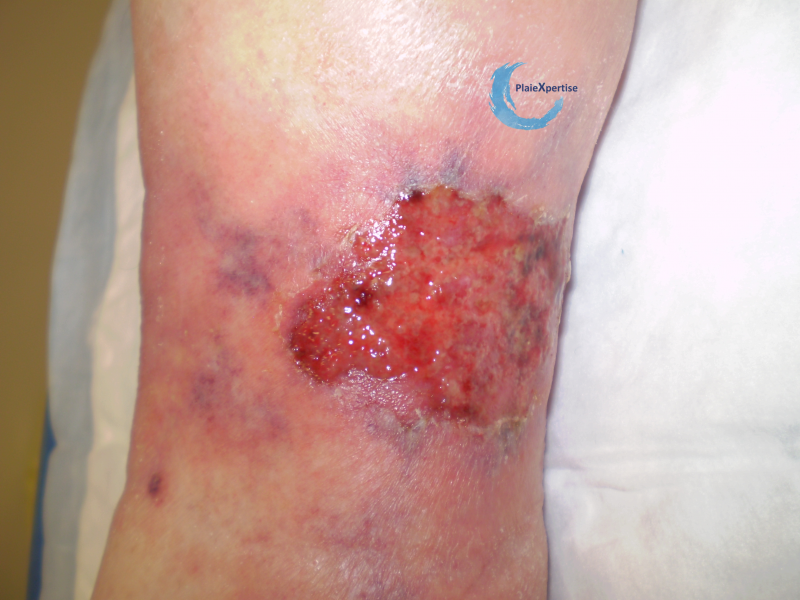 Fichier:Angiodermite atypique17.png