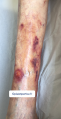 Dermatoporose12.png