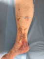 Dermiteocre33.png