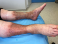 Dermiteocre43.png