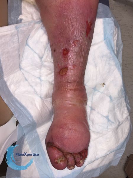 Fichier:Lymphoedème71.jpg