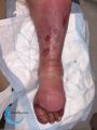 Lymphoedème71.jpg